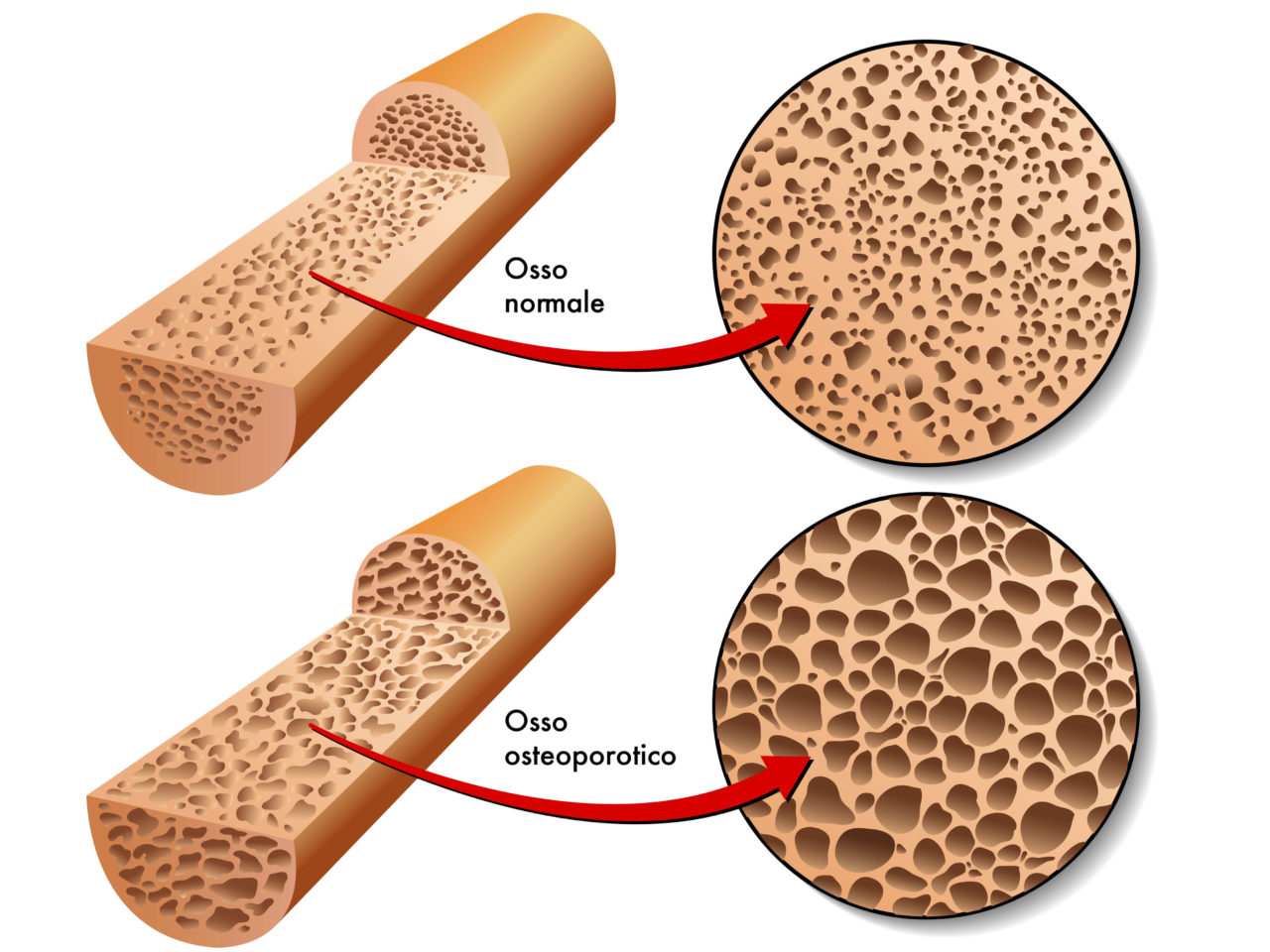 Osteoporosi cos è come riconoscerla e come prevenirla Fond G Restelli